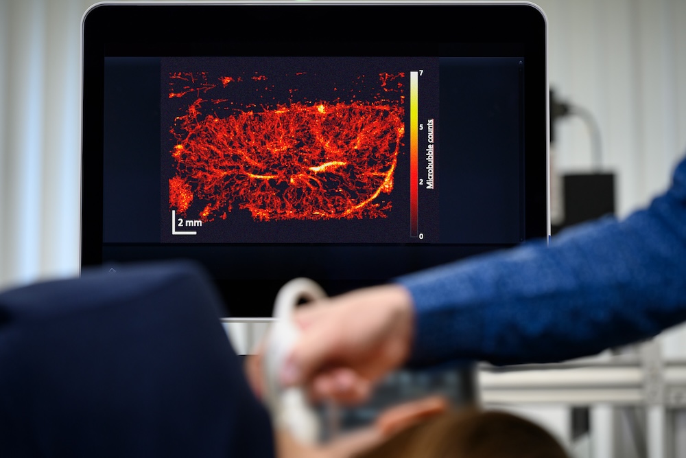 Auf dem Bildschirm zeigt die Ultraschall-Lokalisations-Mikroskopie die Bläschen.