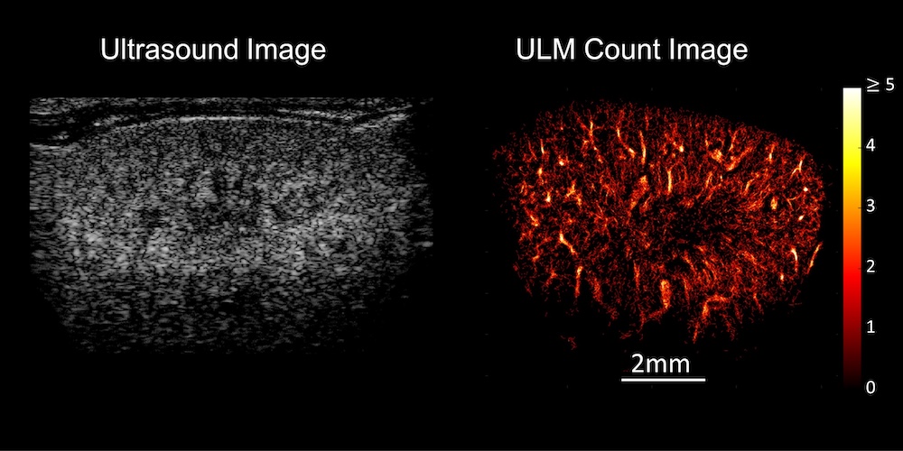 Das Bild zeigt die herkömmliche Ultraschallmethode sowie die Ultraschall-Lokalisations-Mikroskopie (re.) anhand einer Mausniere.