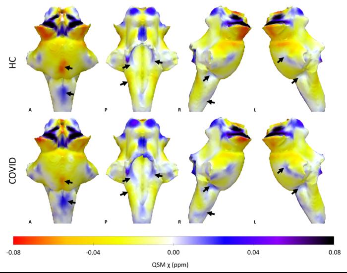 Long Covid MRT-Scan